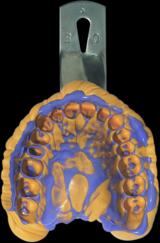 gum Abdrucklöffel mit Material